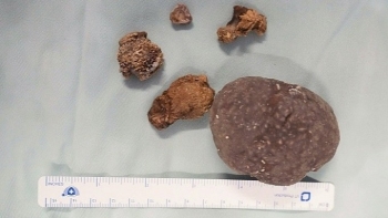 Cảnh báo sỏi thận lâu năm biến chứng thành ung thư