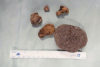 Cảnh báo sỏi thận lâu năm biến chứng thành ung thư