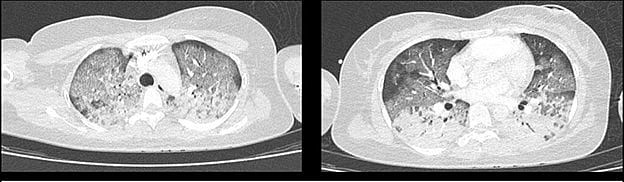 Phổi bệnh nhân bị tổn thương được chụp cắt lớp vi tính. Ảnh BVCC