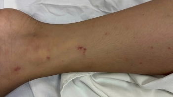 Vượt qua nguy kịch nhờ điều trị viêm màng não mô cầu kịp thời