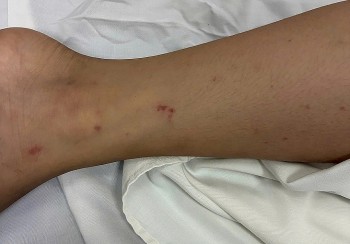 Vượt qua nguy kịch nhờ điều trị viêm màng não mô cầu kịp thời