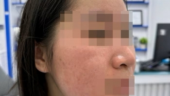 Trị mụn bằng chanh: Hậu quả đáng sợ sau khi thử "mẹo" trên mạng