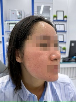 Trị mụn bằng chanh: Hậu quả đáng sợ sau khi thử "mẹo" trên mạng