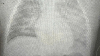 Bé gái 8 tuổi nguy kịch vì sởi, hai lá phổi trắng xóa