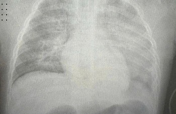 Bé gái 8 tuổi nguy kịch vì sởi, hai lá phổi trắng xóa