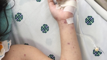 Viêm não mô cầu: Căn bệnh gây tử vong nhanh chỉ sau một ngày nhiễm