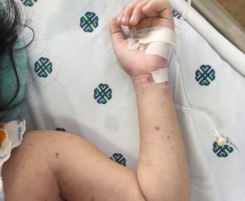 Xuất hiện ban da (sẩn hồng ban chuyển thành chấm xuất huyết hoặc bọng nước). Xuất hiện ban da (sẩn hồng ban chuyển thành chấm xuất huyết hoặc bọng nước).