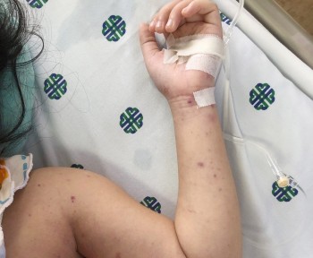 Viêm não mô cầu: Căn bệnh gây tử vong nhanh chỉ sau một ngày nhiễm