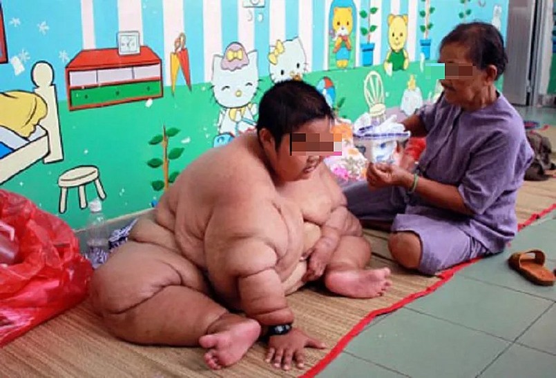 Bệnh nhi bị thừa cân béo phì điều trị tại Bệnh viện Nhi Đồng 1