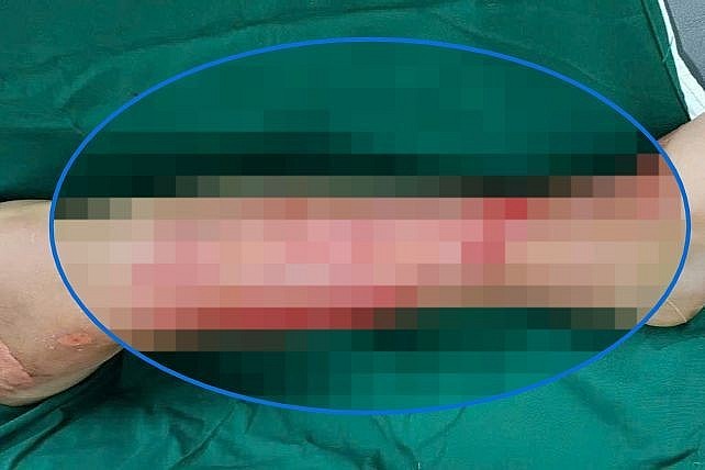 Vết thương của một bệnh nhân tự dùng thuốc điều trị bỏng.