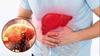 Dấu hiệu cảnh báo có thể bạn đang bị men gan cao