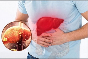 Dấu hiệu cảnh báo có thể bạn đang bị men gan cao