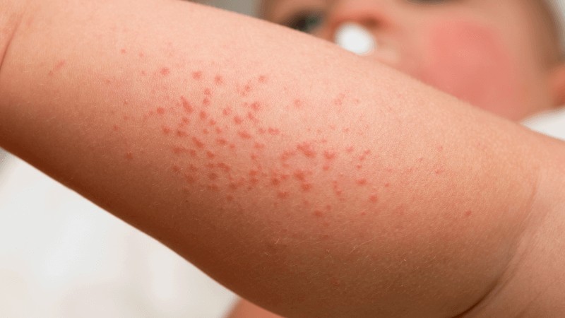 Bộ Y tế cảnh báo: Không được bỏ qua những dấu hiệu nguy hiểm của sốt xuất huyết