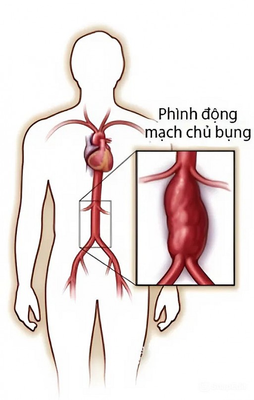 Trong nghiên cứu trên 305 bệnh nhân phẫu thuật tim, khoảng 60% người bị phình động mạch chủ có ngón tay cái vượt quá rìa lòng bàn tay khi làm bài kiểm tra.
