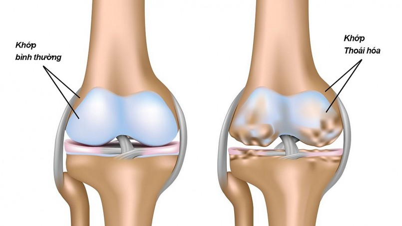Thoái hóa khớp gối là dạng viêm khớp phổ biến nhất, đặc biệt thường gặp ở người cao tuổi.