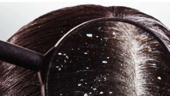 Thói quen thường ngày âm thầm “nuôi dưỡng” gàu