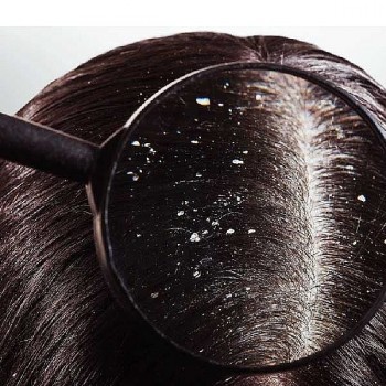 Thói quen thường ngày âm thầm “nuôi dưỡng” gàu