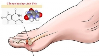 Axit uric cao: “Kẻ thù giấu mặt” của sức khỏe