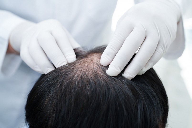 Thăm khám và soi nang tóc giúp chẩn đoán chính xác mức độ tổn thương để điều trị hiệu quả.