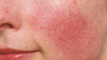 Bí quyết phục hồi da cháy nắng mùa hè tại nhà