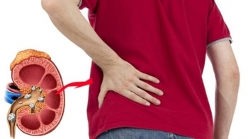 Ăn mặn không chỉ hại thận