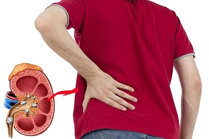 Khi bạn ăn quá mặn, thận phải làm việc quá sức để loại bỏ natri.