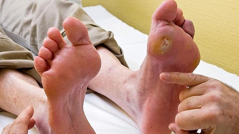 Những biến chứng bị bỏ quên của bệnh tiểu đường