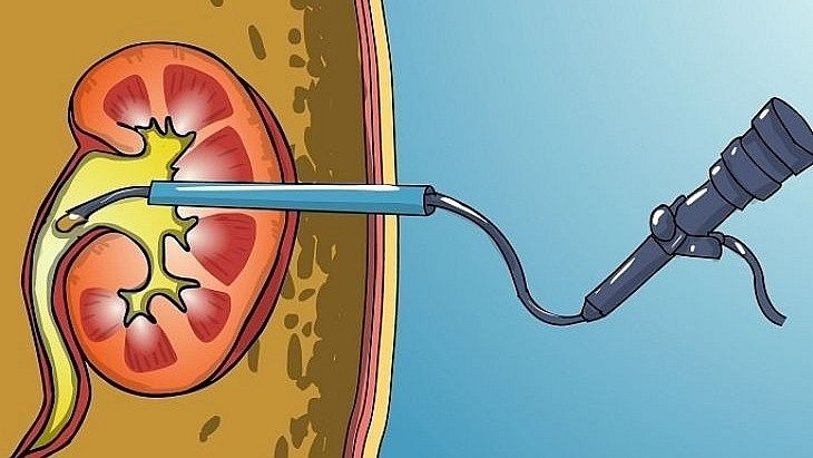 Kỹ thuật tán sỏi qua da – tạo đường hầm nhỏ vào thận để phá vỡ và lấy sỏi ra ngoài, ít xâm lấn, giúp bệnh nhân phục hồi nhanh.