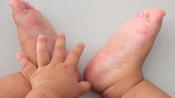 Bệnh tay chân miệng bùng phát mạnh, Bộ Y tế ra công văn khẩn