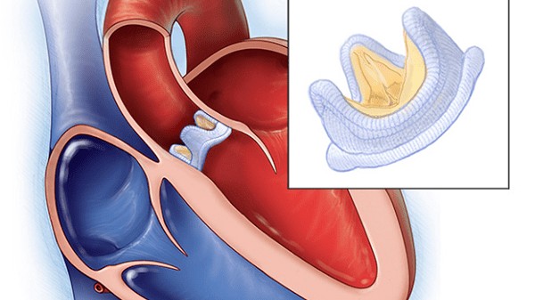 Bệnh van tim gây ra nguy cơ đột tử ở 150.000 người Việt