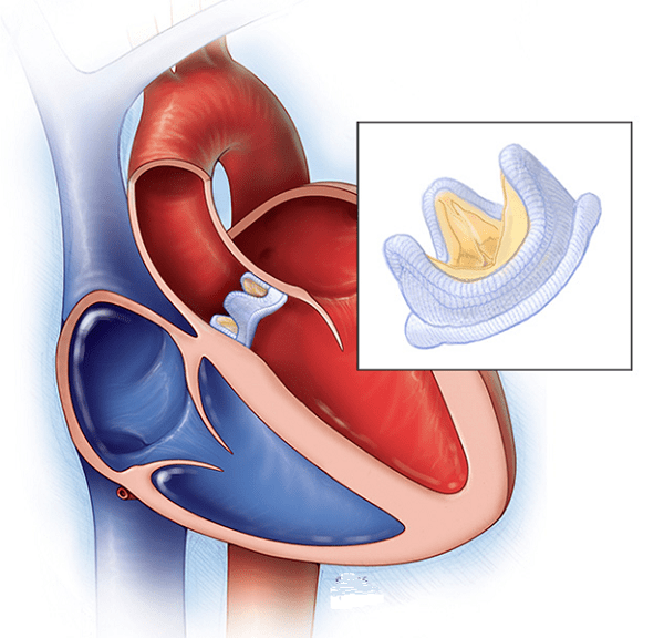 Hẹp van động mạch chủ là một trong những bệnh lý van tim phổ biến và nguy hiểm nhất ở người cao tuổi