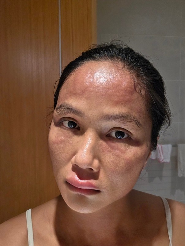 Hoa hậu H\'Hen Niê đã đăng tải hình ảnh gương mặt sưng tấy.