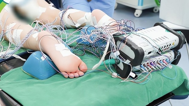 Bệnh nhi được đặt điện sinh lý để tìm dây thần kinh gây co cứng.