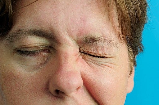 Liệt dây thần kinh số 7 ngoại biên là tình trạng dây thần kinh này bị tổn thương ở phần ngoại biên, gây ra tình trạng liệt gần như toàn bộ các cơ ở một nửa mặt.