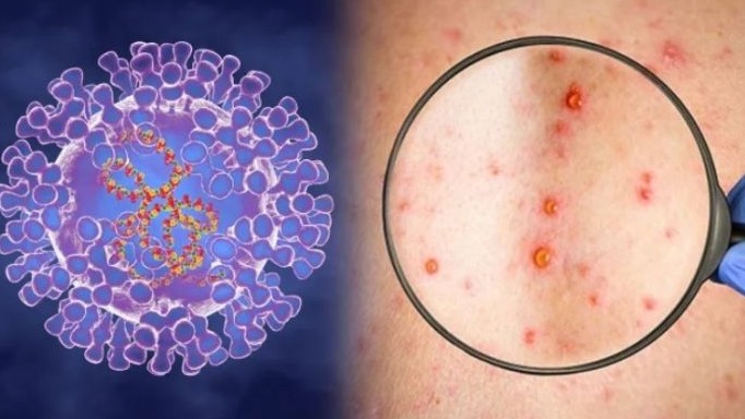 WHO: Virus gây bệnh đậu mùa khỉ tiếp tục lây lan