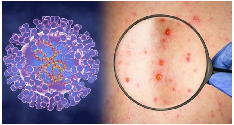 WHO: Virus gây bệnh đậu mùa khỉ tiếp tục lây lan