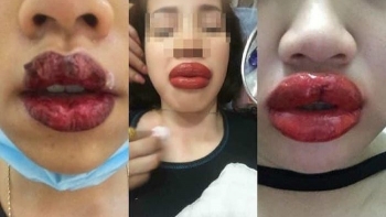 Khuyến cáo: Cẩn trọng với phun xăm thẩm mỹ