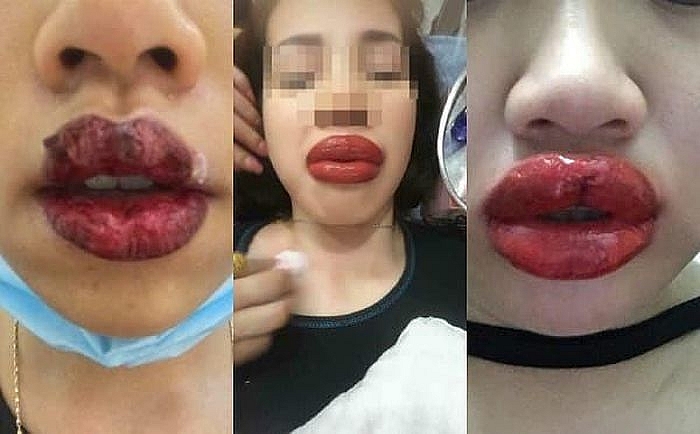 Khuyến cáo: Cẩn trọng với phun xăm thẩm mỹ