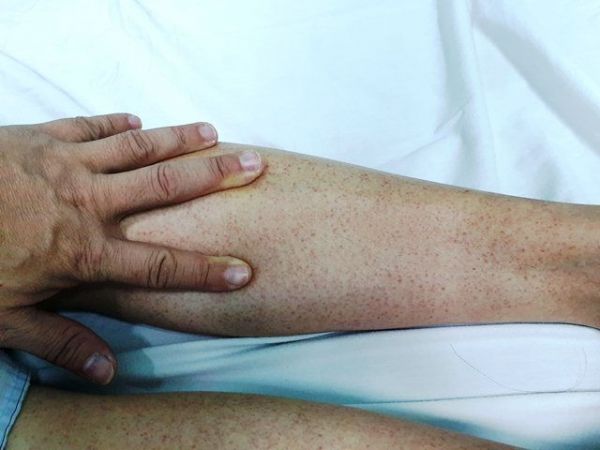 Trong 1 tuần, Hà Nội có thêm hàng trăm ca mắc sốt xuất huyết